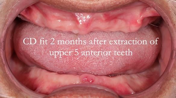 Finlay's Newsletter 62 provision of extractions and metal based complete dentures for Rafique
