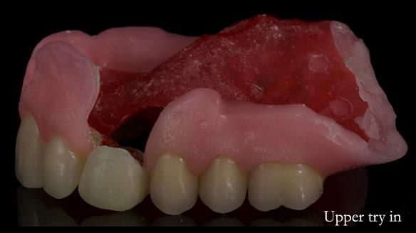 Newsletter 55 Provision of metal based partial dentures for Zephyrine with a repaired cleft lip and palate
