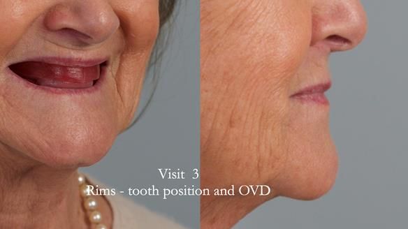 Lip Support Incisal plane - level with IPD Occlusal plane - level with ala-tragus Buccal corridors - as per dentate picture Centre line - as per dentate picture OVD - if they look right - they are right
