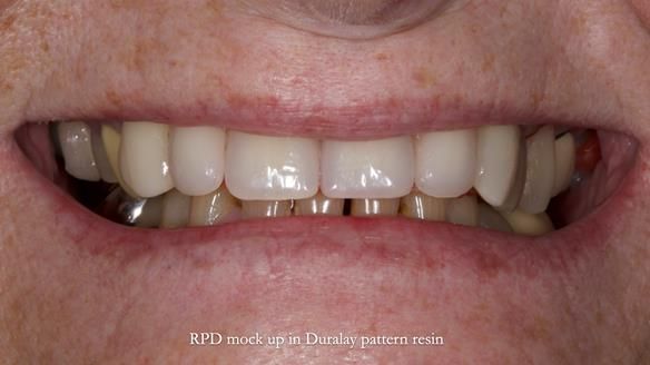 Newsletter 81 - Pam’s Story — how a partial denture changed her life (+ live walkthrough this Thursday)