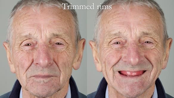 Newsletter 80 - Gordon’s dentures: the one case in 1,000 where my technique failed