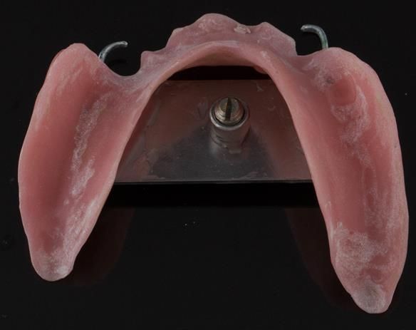 Figure 84 Visit 3 for Mk 2 fabrication. Inter-maxillary registration with central bearing apparatus made on light cured tray maker for accurate CR recording - mandibular fitting surface