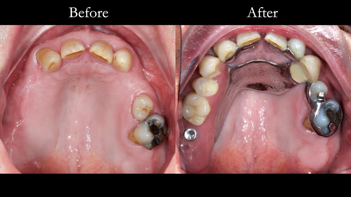 Newsletter 86 Peter the Architect — precision removable partial dentures case study