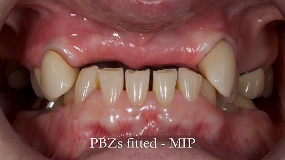 Newsletter 81 - Pam’s Story — how a partial denture changed her life (+ live walkthrough this Thursday)