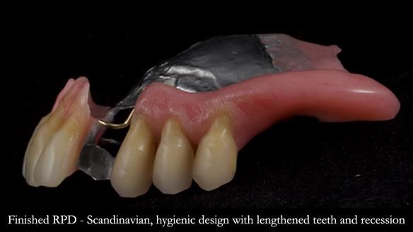 Finlay's Newsletter 59 Ultra hard partial dentures made for Gill