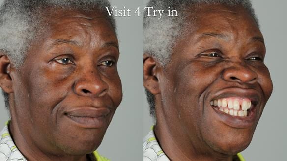 Newsletter 53 showing the making and fitting of ultra life-like dentures for Valena