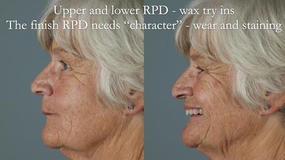 Eileen's transformation with upper and lower RPDs of Scandinavian hygienic design FULL PROTOCOL