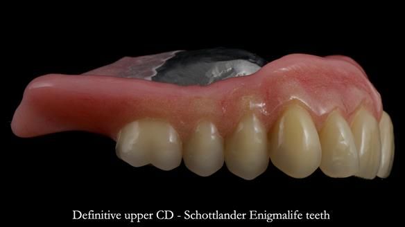 Newsletter 82 Mary - A complete upper and a one-tooth gasket denture