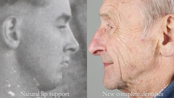 Newsletter 80 - Gordon’s dentures: the one case in 1,000 where my technique failed