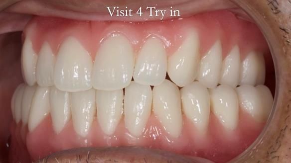 Managing poor implant positioning with complete dentures and Locator attachments - full protocol Newsletter 41