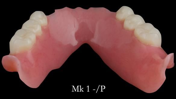Newsletter 52 Managing Jo’s failing dentition with extractions and Mk 1/Mk 2 complete upper dentures and lower partial dentures FULL PROTOCOL