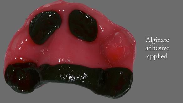 Newsletter 52 Managing Jo’s failing dentition with extractions and Mk 1/Mk 2 complete upper dentures and lower partial dentures FULL PROTOCOL