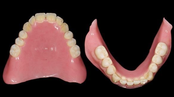 Newsletter 80 - Gordon’s dentures: the one case in 1,000 where my technique failed