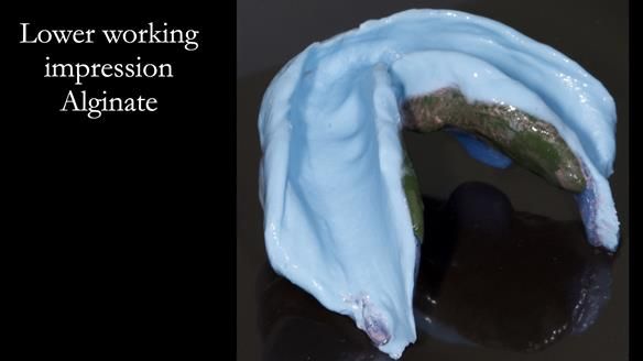 Newsletter 53 showing the making and fitting of ultra life-like dentures for Valena