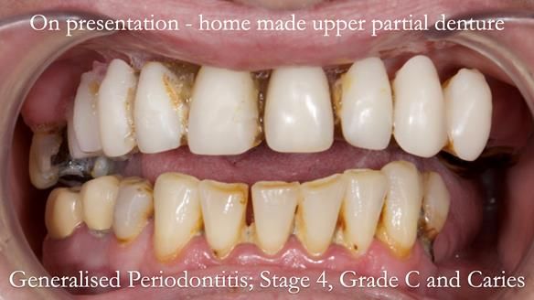 Newsletter 52 Managing Jo’s failing dentition with extractions and Mk 1/Mk 2 complete upper dentures and lower partial dentures FULL PROTOCOL