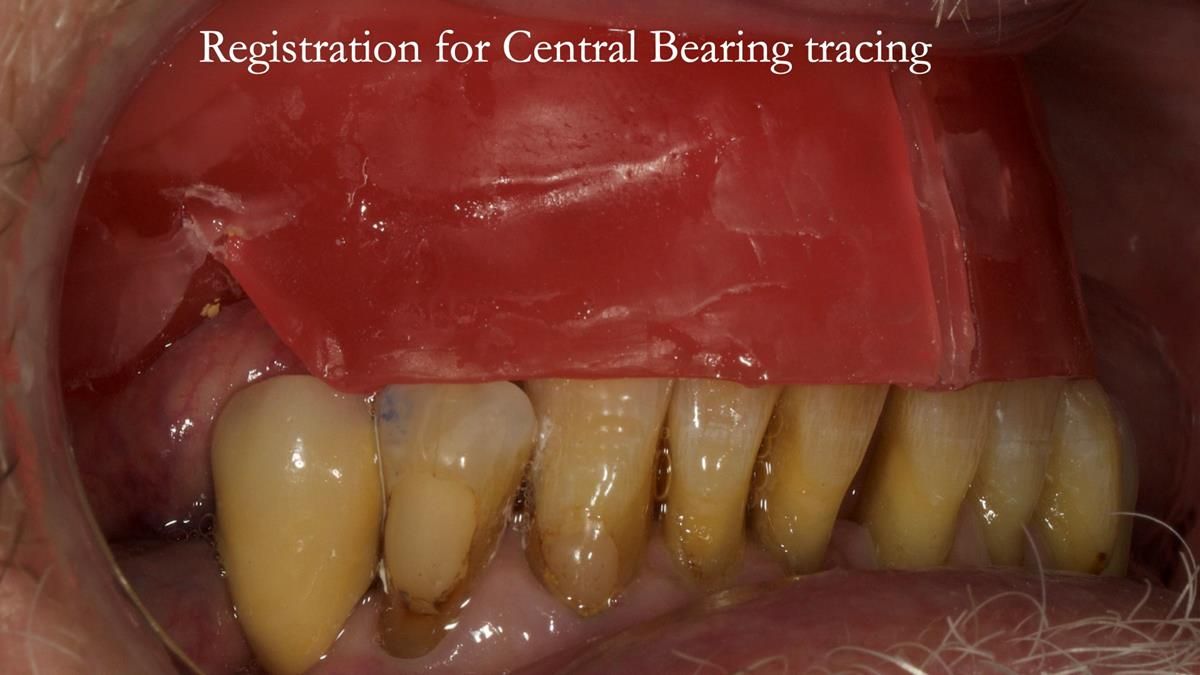 Newsletter 87 – Father Peter: A Partial Denture that needed Minor Miracle
