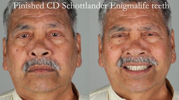 Finlay's Newsletter 62 provision of extractions and metal based complete dentures for Rafique