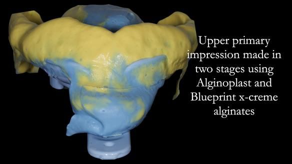 Newsletter 52 Managing Jo’s failing dentition with extractions and Mk 1/Mk 2 complete upper dentures and lower partial dentures FULL PROTOCOL