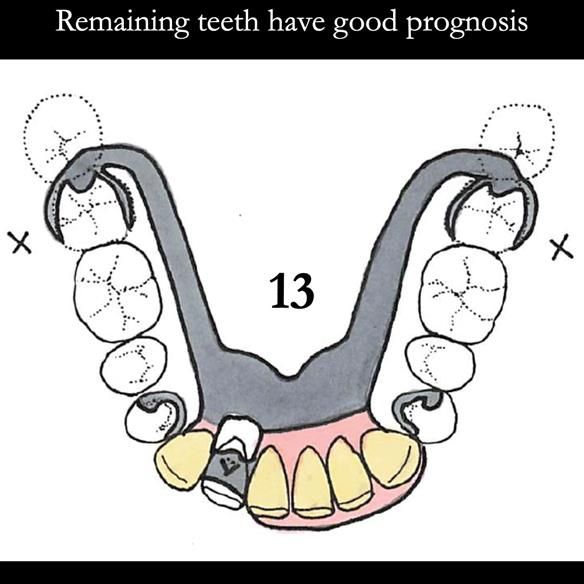 Universal Scandinavian partial denture designs