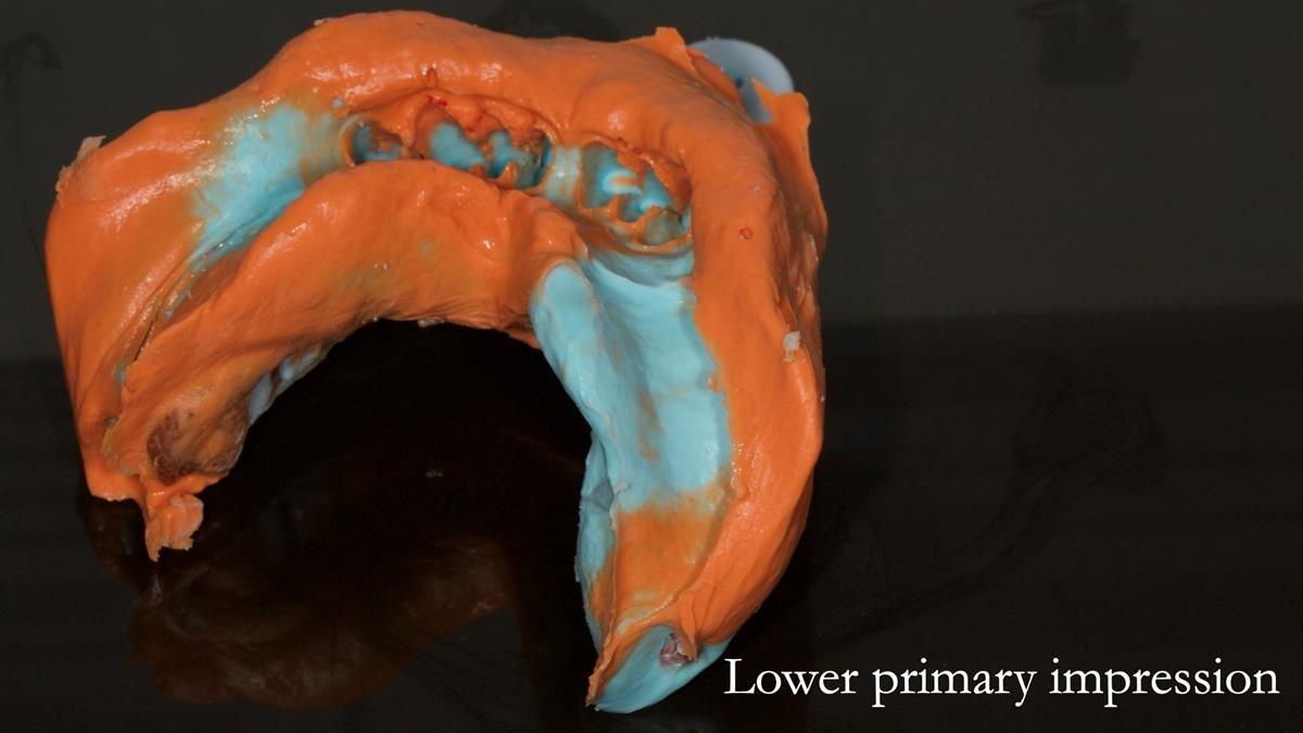 Newsletter 87 – Father Peter: A Partial Denture that needed Minor Miracle