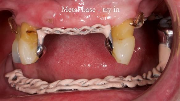 Finlay's Newsletter 59 Ultra hard partial dentures made for Gill