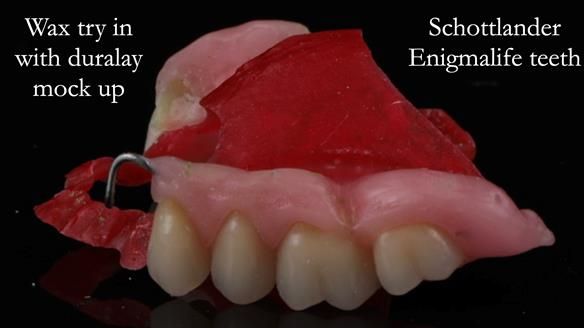 Finlay's Newsletter 60 Sylvia's upper Kennedy Class 2 Mod 1 metal based upper RPD