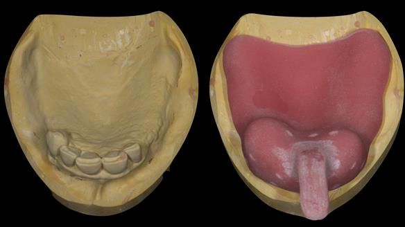 Finlay's Case Study Newsletter 40 - Immediate Mk 1 RPD to Definitive Mk 2 RPD - full protocol