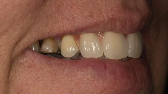 Finlay's Newsletter 63 Case study provision of metal based Scandinavian RPD - functional 10 years on
