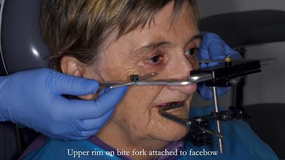 Newsletter 83: Sheila’s Complete Denture Success