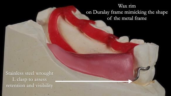 Finlay's Newsletter 61 provision of a lower unilateral free end saddle metal based partial denture for Joyce