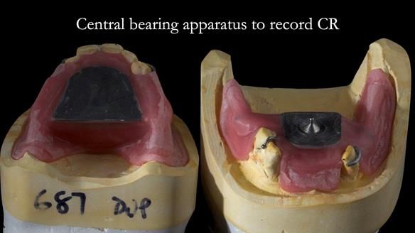 Finlay's Case Study Newsletter 40 - Immediate Mk 1 RPD to Definitive Mk 2 RPD - full protocol