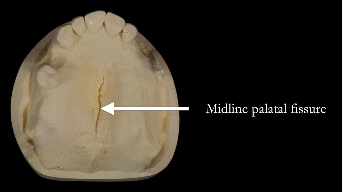 Newsletter 89 – Simon: A Challenging Kennedy Class II Division 1 Upper CoCr Partial Denture with a High Smile Line