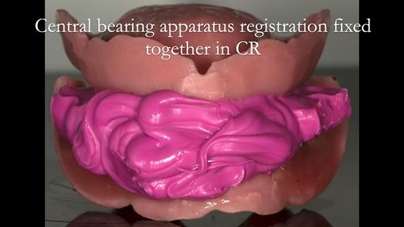 Newsletter 75: Marion’s case - Step-by-step complete denture workflow