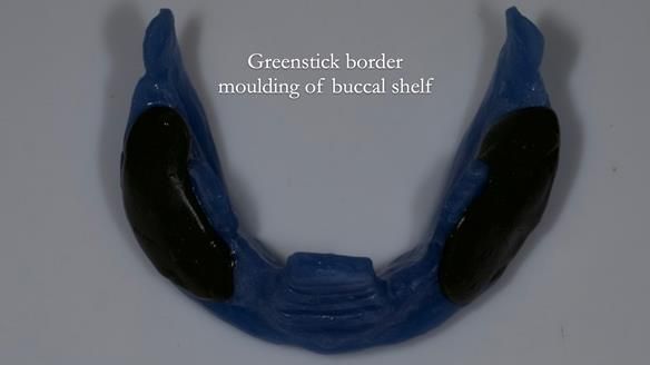 Newsletter 83: Sheila’s Complete Denture Success