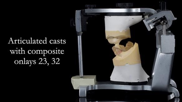 Newsletter 55 Provision of metal based partial dentures for Zephyrine with a repaired cleft lip and palate