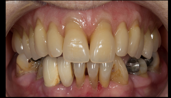 Figure 102 Mk 2 fitted definitive denture - Schottlander Enigmalife teeth teeth together - occlusion in CR