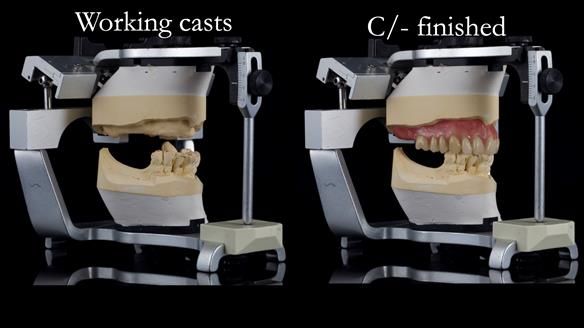 Newsletter 54 case presentation upper complete denture and lower Scandinavian designed hygienic partial denture for David