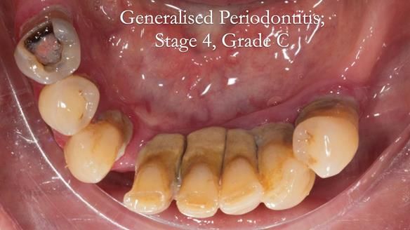Finlay's Case Study Newsletter 40 - Immediate Mk 1 RPD to Definitive Mk 2 RPD - full protocol