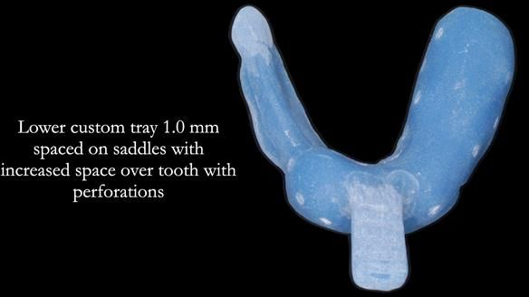 Finlay's Newsletter 61 provision of a lower unilateral free end saddle metal based partial denture for Joyce