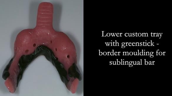 Finlay's Case Study Newsletter 40 - Immediate Mk 1 RPD to Definitive Mk 2 RPD - full protocol