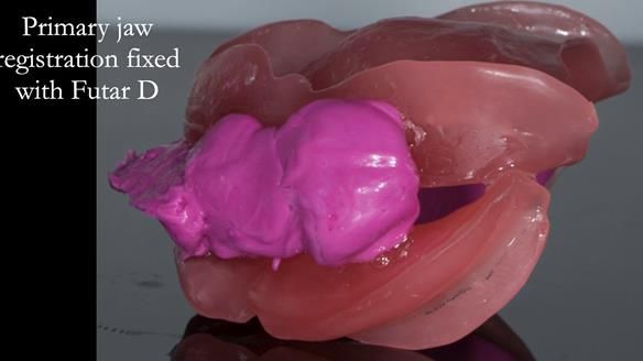 Newsletter 75: Marion’s case - Step-by-step complete denture workflow