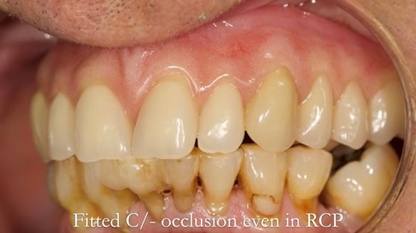 Newsletter 54 case presentation upper complete denture and lower Scandinavian designed hygienic partial denture for David