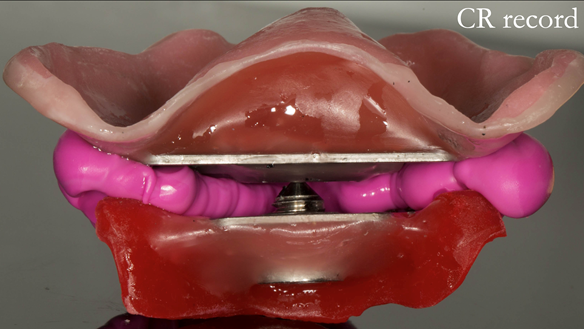 Figure 86 Central bearing apparatus fixed together with Futar D taken out of the mouth showing pin in countersink hole over apex of the arrow