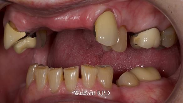 Newsletter 81 - Pam’s Story — how a partial denture changed her life (+ live walkthrough this Thursday)