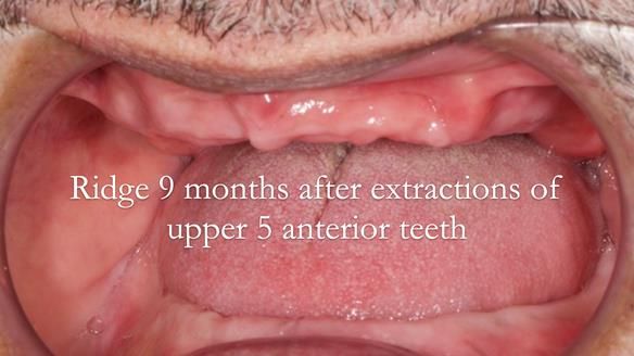 Finlay's Newsletter 62 provision of extractions and metal based complete dentures for Rafique