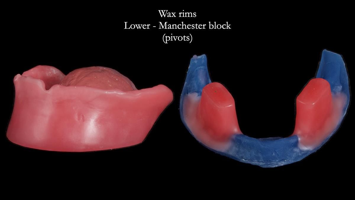 Fin’s Newsletter 88 — Complete dentures - full protocol… he rearranged his own teeth!