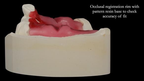 Newsletter 55 Provision of metal based partial dentures for Zephyrine with a repaired cleft lip and palate