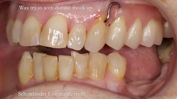 Finlay's Newsletter 60 Sylvia's upper Kennedy Class 2 Mod 1 metal based upper RPD