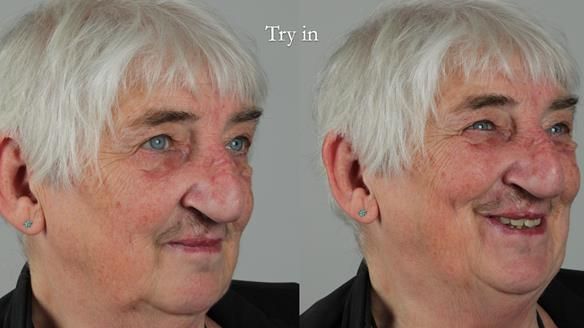 Newsletter 55 Provision of metal based partial dentures for Zephyrine with a repaired cleft lip and palate