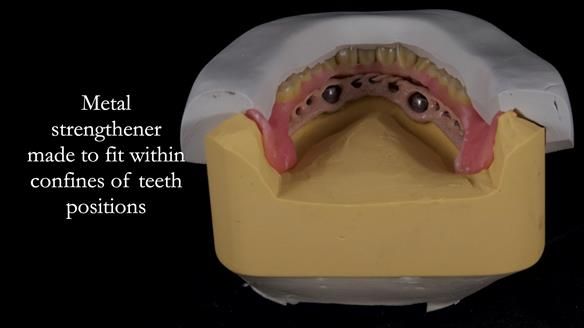 Newsletter 57 showcases the making and fitting process of implant-supported complete dentures for Alisdair
